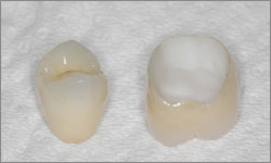 Zircone couronne dentaire